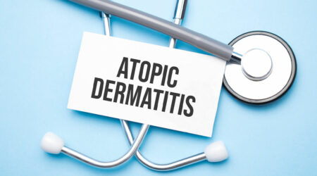 Atopic dermatitis &#8211; Symptoms, triggers, and management