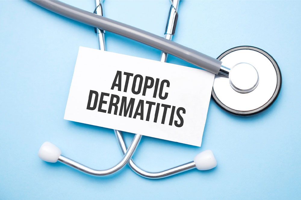 Atopic dermatitis &#8211; Symptoms, triggers, and management