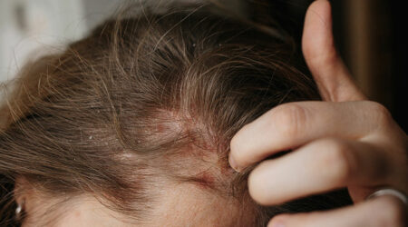 Scalp psoriasis &#8211; Symptoms, causes, and more