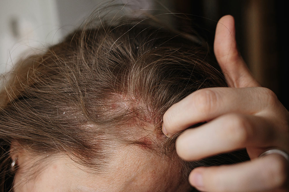 Scalp psoriasis &#8211; Symptoms, causes, and more