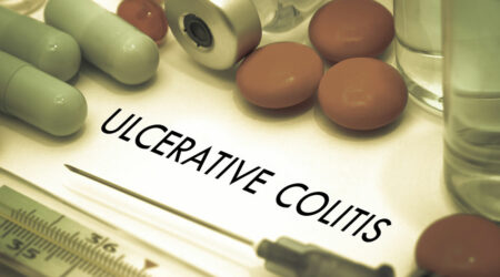 Ulcerative colitis signs, causes, and how to manage it