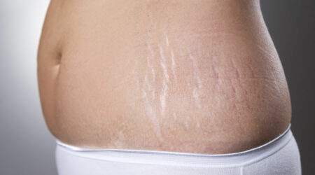 Managing stretch marks &#8211; Causes, remedies, and more