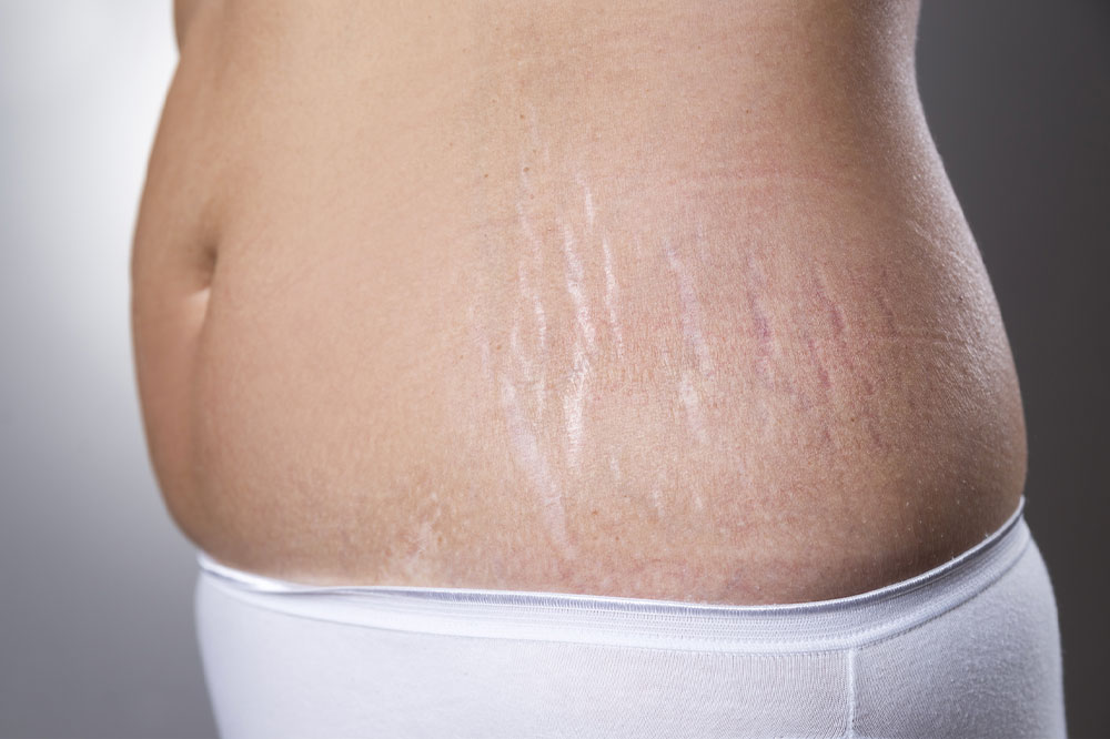 Managing stretch marks &#8211; Causes, remedies, and more