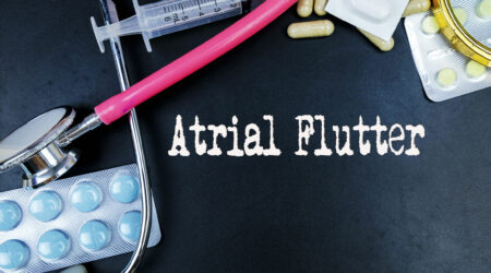 Atrial flutter &#8211; Types, symptoms, causes, and diagnosis