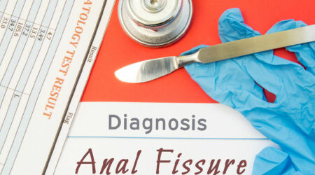 Causes, symptoms, and management of anal fissures