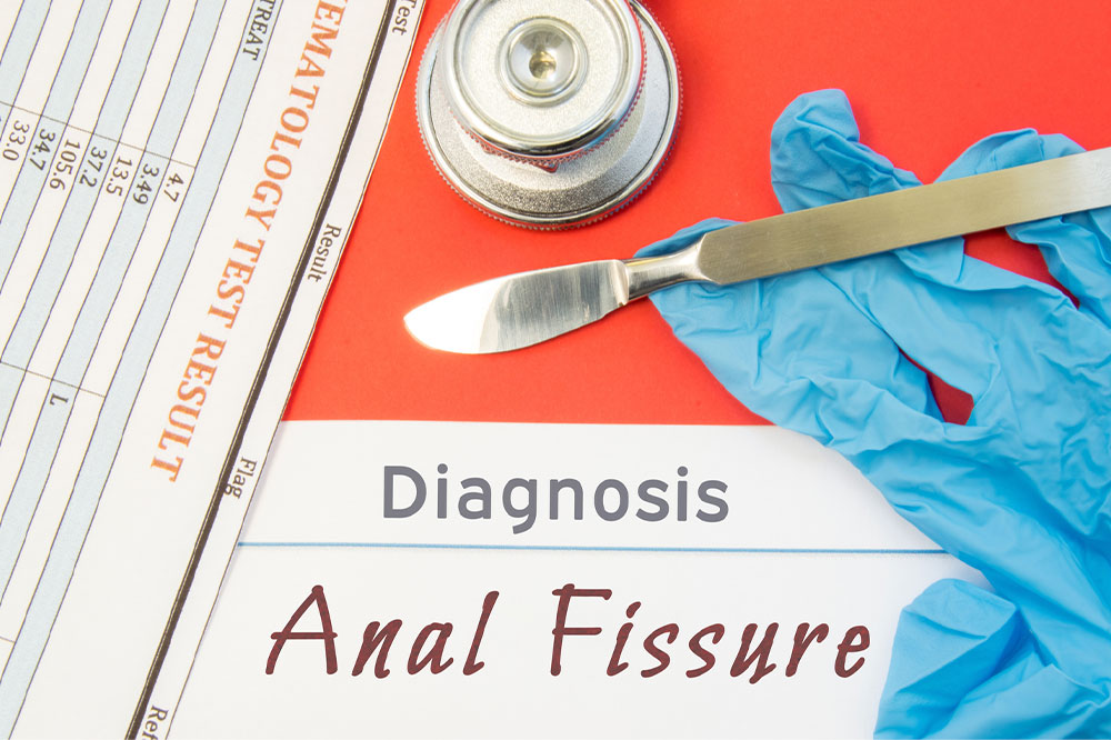 Causes, symptoms, and management of anal fissures