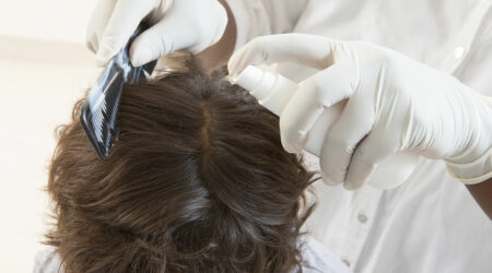 Causes, symptoms, and management for head lice