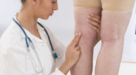 Symptoms, causes, and management of varicose veins