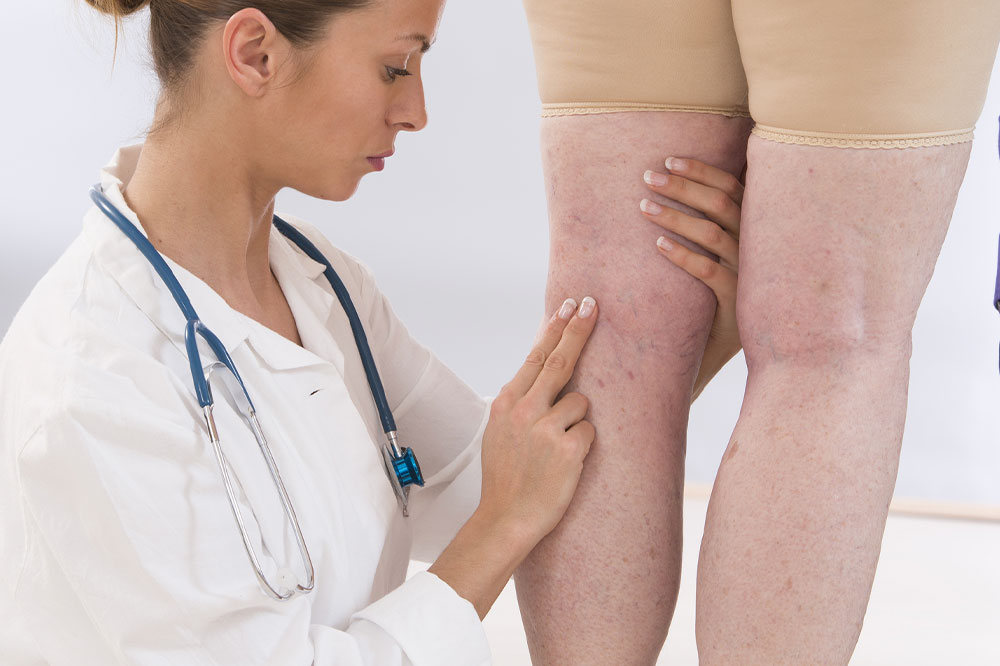 Symptoms, causes, and management of varicose veins