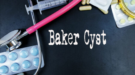 What are the signs of a Baker cyst and how to manage it