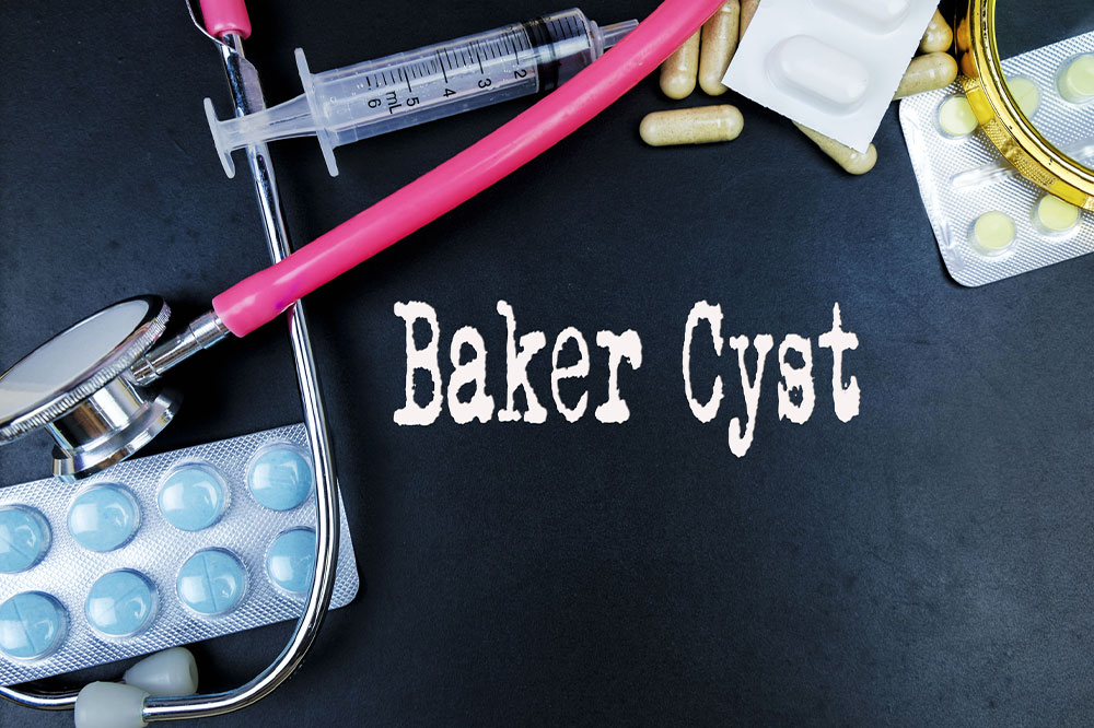 What are the signs of a Baker cyst and how to manage it