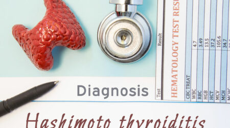 Hashimoto&#8217;s thyroiditis &#8211; Symptoms, causes, and management