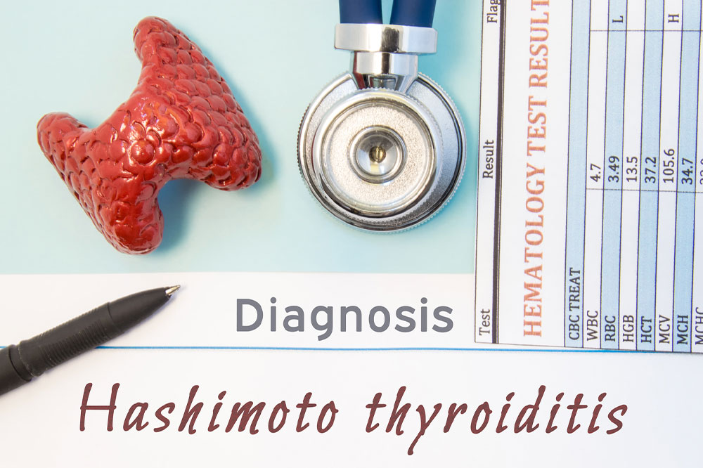 Hashimoto&#8217;s thyroiditis &#8211; Symptoms, causes, and management