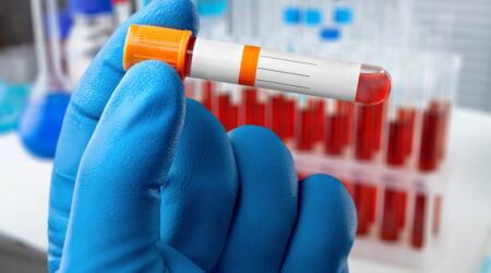 Important factors to know about hematocrit test