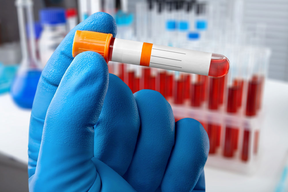 Important factors to know about hematocrit test