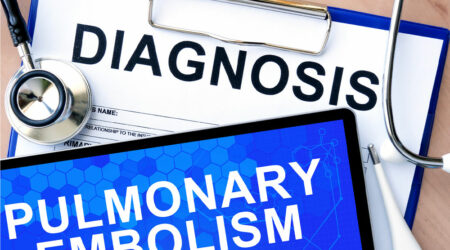 Pulmonary embolism &#8211; Causes, symptoms, and management options