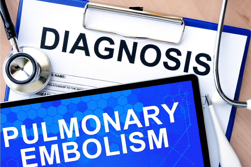 Pulmonary embolism &#8211; Causes, symptoms, and management options